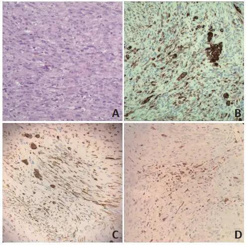 儿童大鱼际恶性蝾螈瘤1例