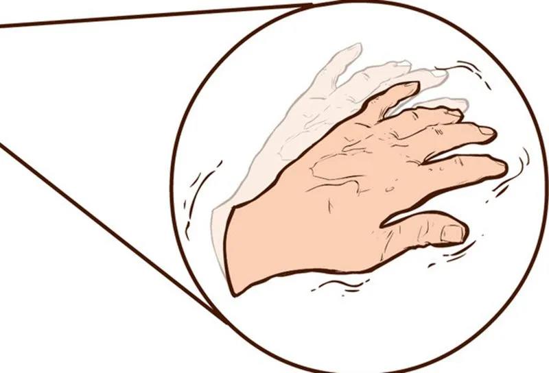 为何这几类帕金森病更易被误诊？