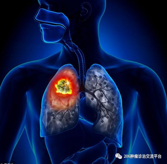 为什么肺癌转移得快 肺癌可以转移到哪些部位
