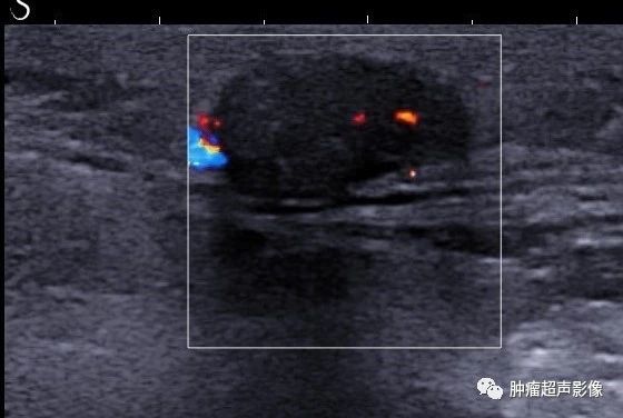 毛母质瘤的超声诊断及分型