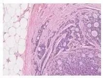 乳腺腺样囊性癌肝转移1例