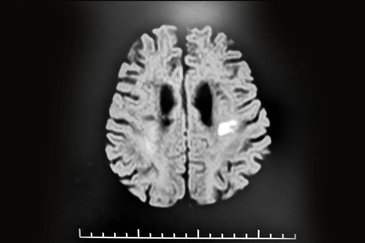 抽丝剥茧 追根溯源     记神经内科张静波主任精确诊断 对症治疗