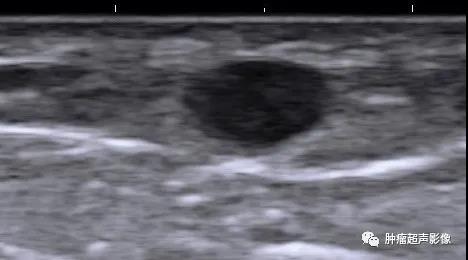 血管平滑肌瘤的超声诊断及鉴别
