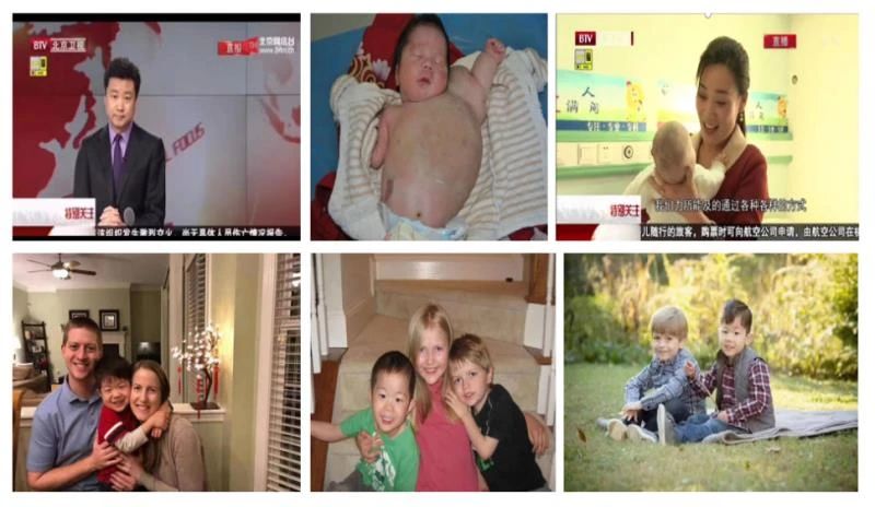 关爱贫困血管瘤儿童