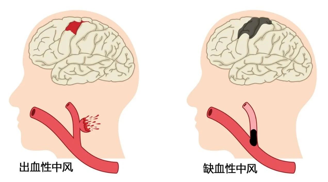39岁男子脑梗导致偏瘫  是什么让中风越来越 年轻化 ？