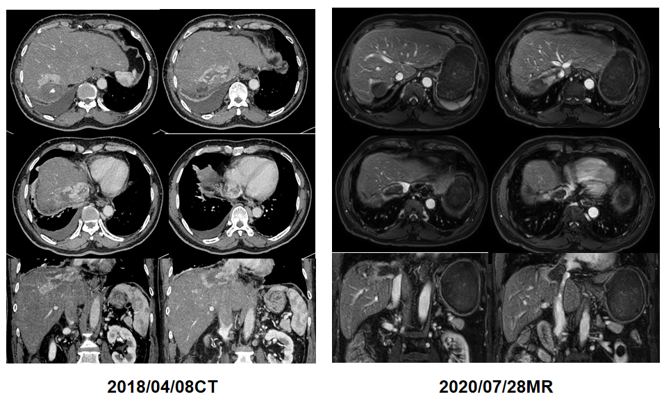 靶向局部双剑合璧有望为超“upto7”BCLC-B期肝癌患者提供联合新获益