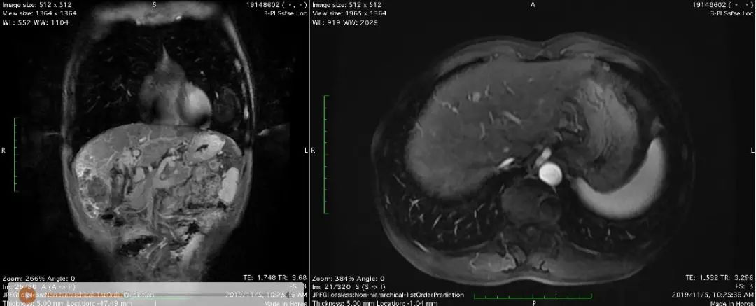 TACE联合索拉非尼序贯瑞戈非尼  晚期肝癌病情得以控制