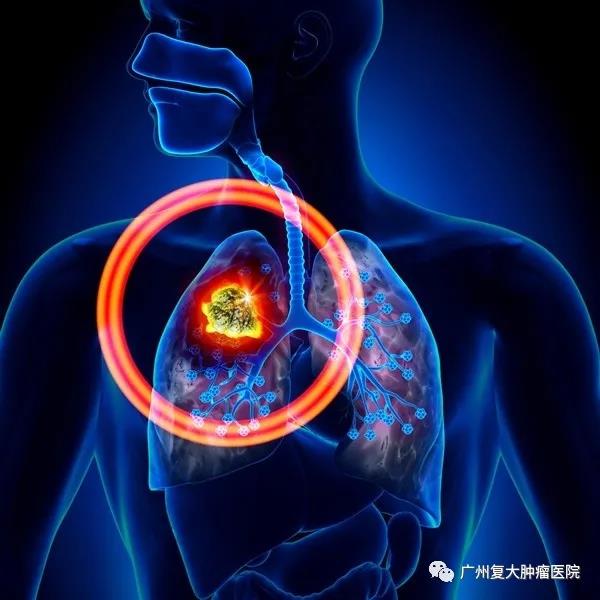 以为咽喉炎却查出肺鳞癌，如何才能减轻痛苦？
