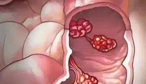 排出这样的粪便   大肠癌可能离你不远了