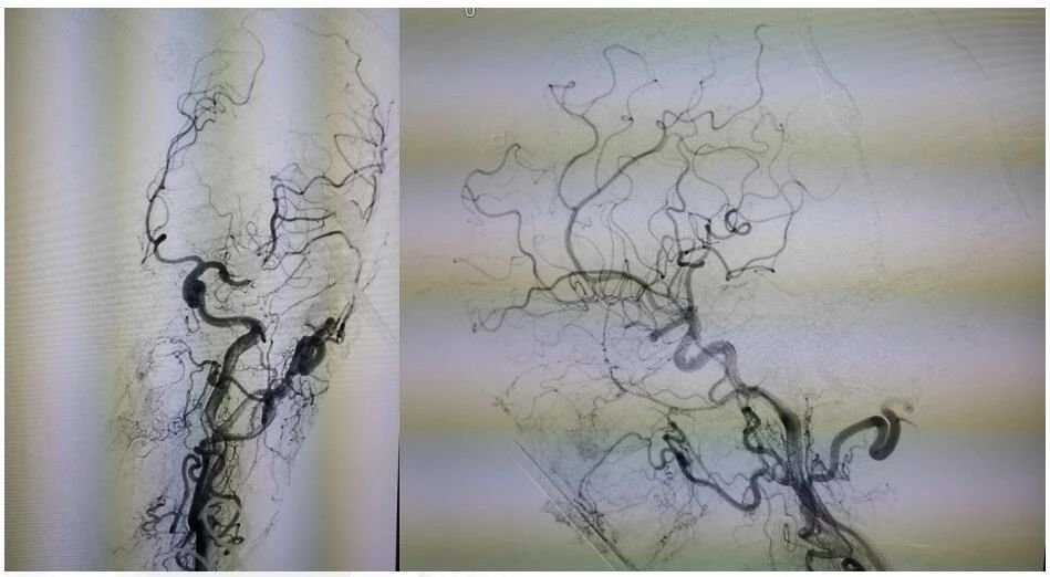 张琪博士团队成功开展  经皮静脉窦穿刺栓塞治疗复杂硬脑膜动静脉瘘 手术
