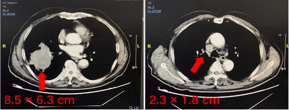 全面覆盖肺鳞癌与腺癌——免疫治疗快速起效，患者可获持久PR！