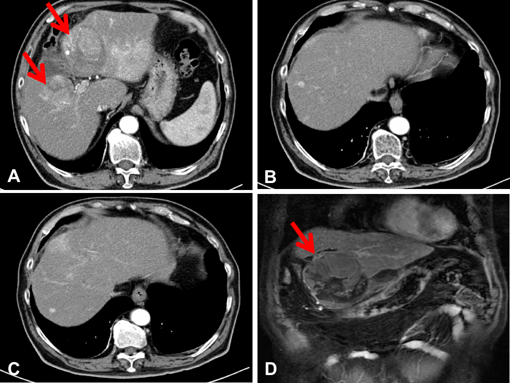 免疫联合治疗可获CR，开启晚期HCC治疗新格局
