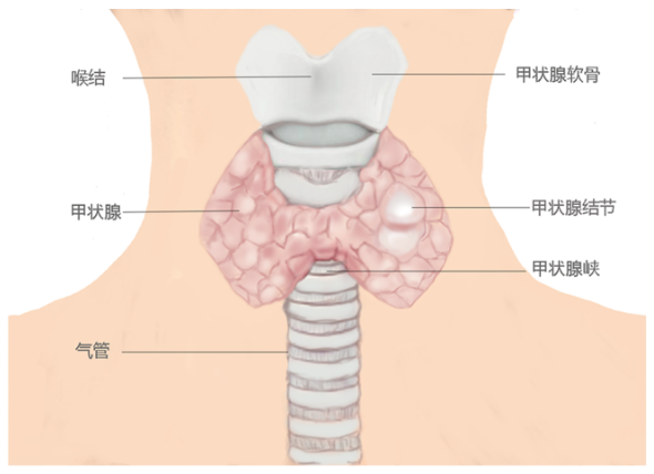 甲状腺结节应该怎么买保险？