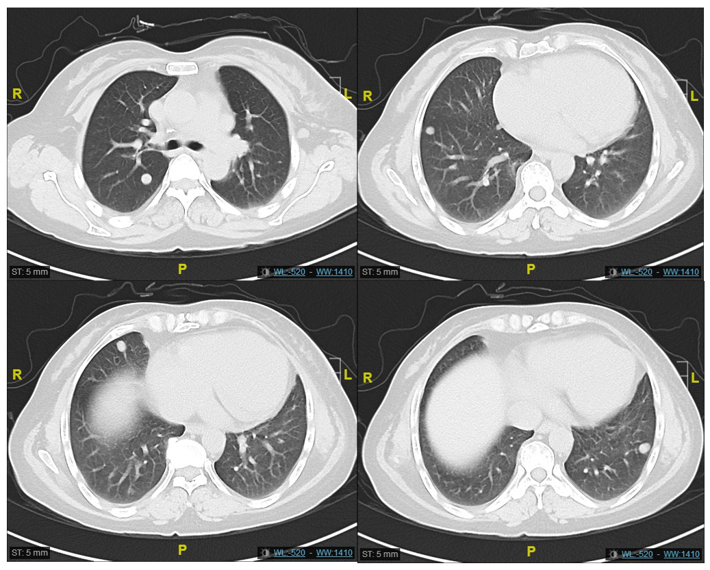靶向联合免疫辅助治疗转移性恶黑，曲折过后柳暗花明！