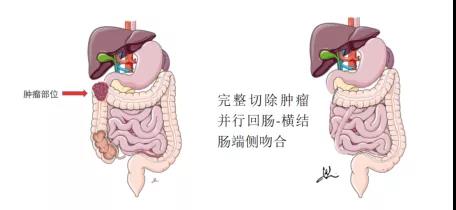 MSI-H局晚结肠癌手术难度大？不惧，免疫+化疗成功转化