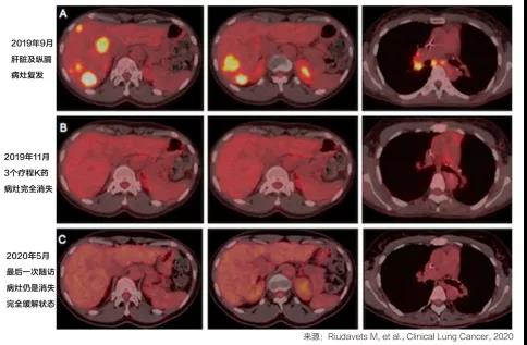 靶向耐药多器官转移，这样用PD-1消除病灶！