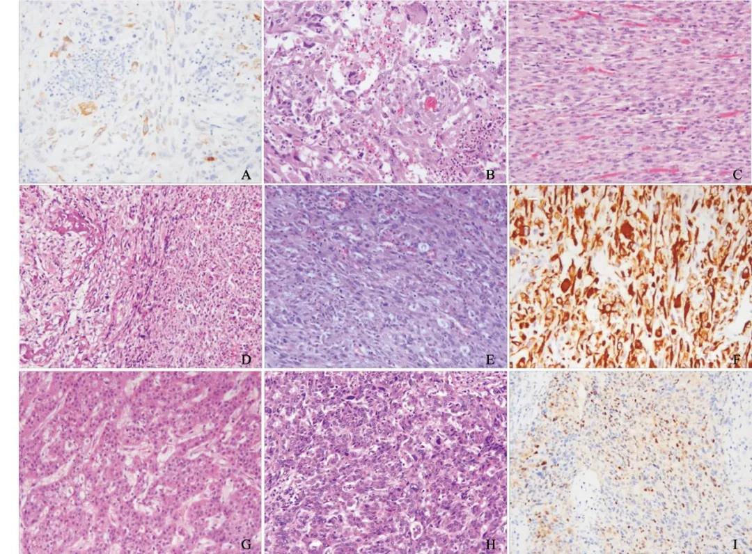 肉瘤样肝细胞癌中MET基因扩增与预后的相关性分析