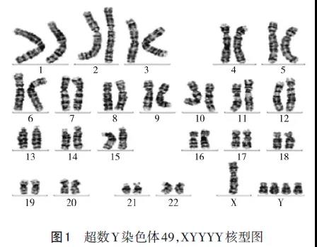 超数Y染色体49 XYYYY核型胎儿的产前诊断并文献复习