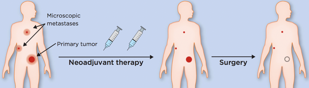 欧狄沃联合化疗为非小细胞肺癌新辅助治疗提供新选择