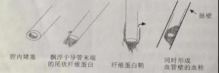 纤维蛋白鞘形成:常常是输液时渗液,停止输液后不出现,采用尿激酶溶栓