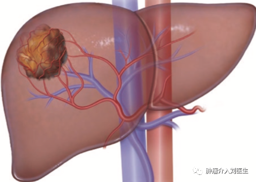 肝癌的多学科治疗策略