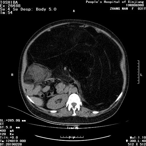 脂肪肉瘤肿瘤界最强伪装者  假扮脂肪却是恶性肿瘤！
