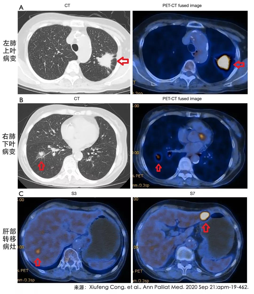 希望时刻——肺癌奥希替尼耐药可以被PD-1联合艾坦逆转