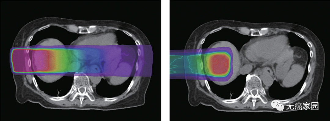 世界领先的放疗新手段！质子治疗带动全球抗癌斗争！