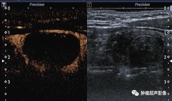 甲状腺皱缩结节的超声诊断