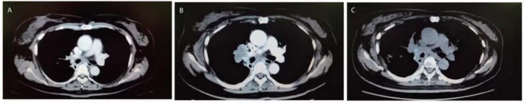 这类肺癌竟会暗度陈仓 在治疗中偷偷变性