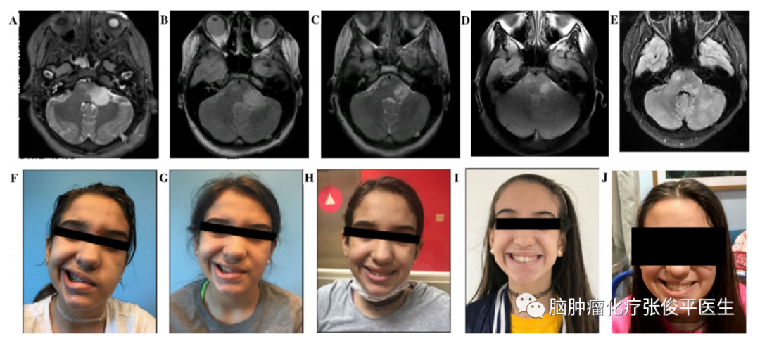 ONC201治疗儿童和成人H3K27M突变型弥漫中线胶质瘤