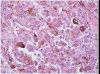 膀胱血管周上皮细胞样肿瘤复发1例