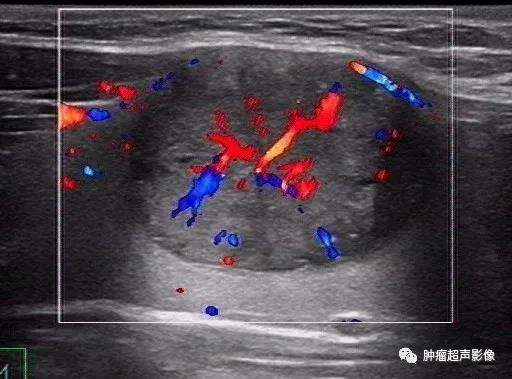 甲状腺乳头状癌之烟花征