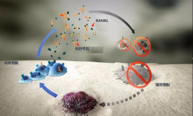 癌细胞骨转移全攻略: 选对正确治疗方案, 斩断骨转“恶性循环”