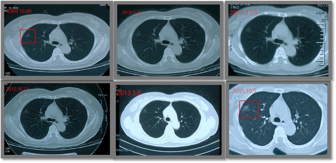 肺磨玻璃样结节？不想长期煎熬那就消融打掉