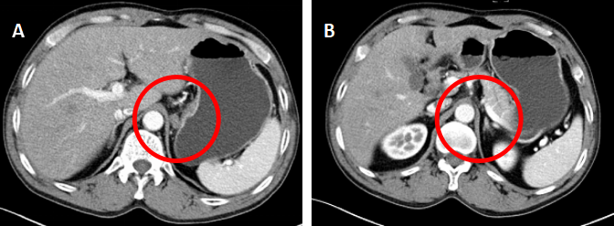再给患者一次选择机会 赫赛汀是这样帮他实现23个月PFS的