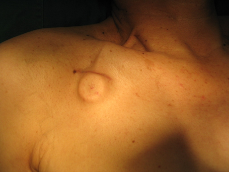 浅谈输液港常见问题及护理