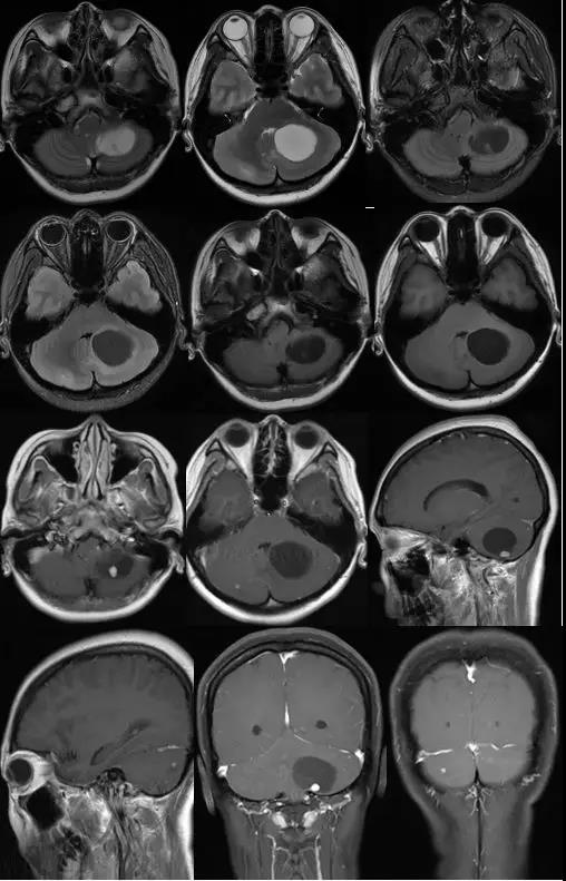 年轻患者脑内有多发血管母细胞瘤，不要忽略这种病！