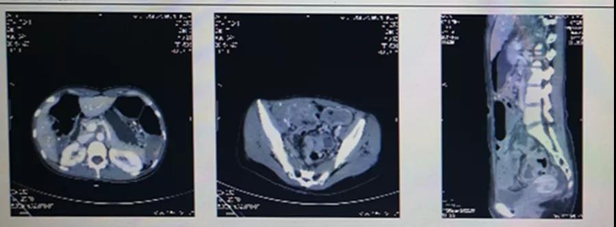 晚期结肠癌患者化疗联合抗血管治疗进展后，下一步治疗何去何从？