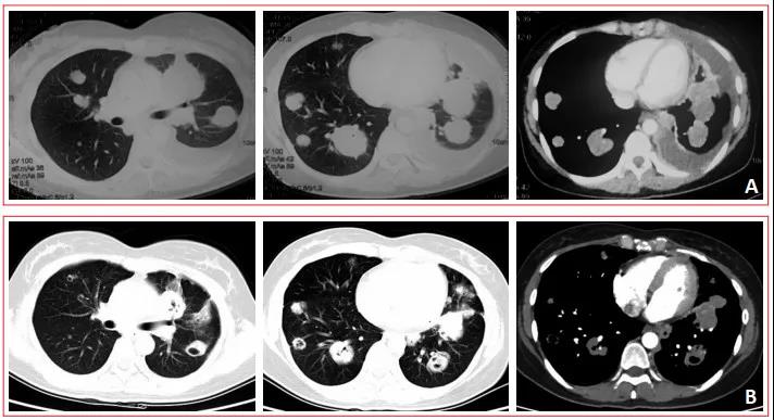 卡瑞利珠单抗联合安罗替尼治疗鼻咽癌1例