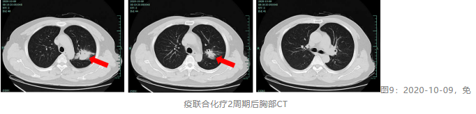 晚期鳞状NSCLC获pCR！替雷利珠单抗联合化疗可迅速缩瘤，为患者带来根治希望