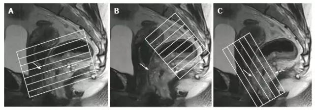 收藏！直肠癌 MRl 诊断指南，入门必备（多图预警）