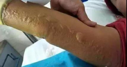 这些输液外渗的处理方法，掌握后会有大用处！