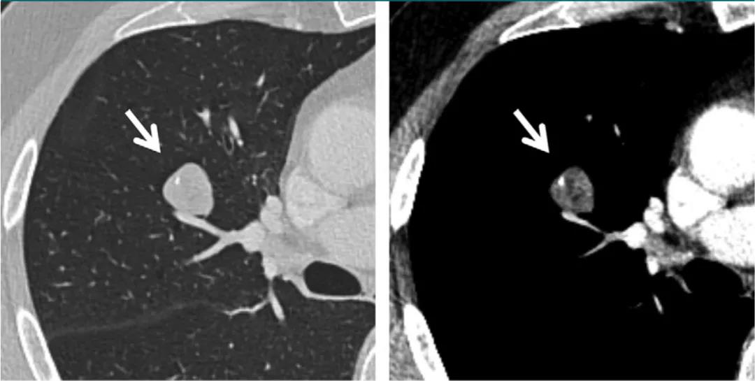 掌握这篇，晋级肺部 CT 影像高手！