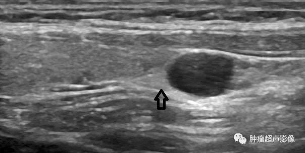 甲状旁腺囊肿的超声诊断