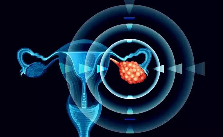 得了卵巢癌 还能做爱吗？