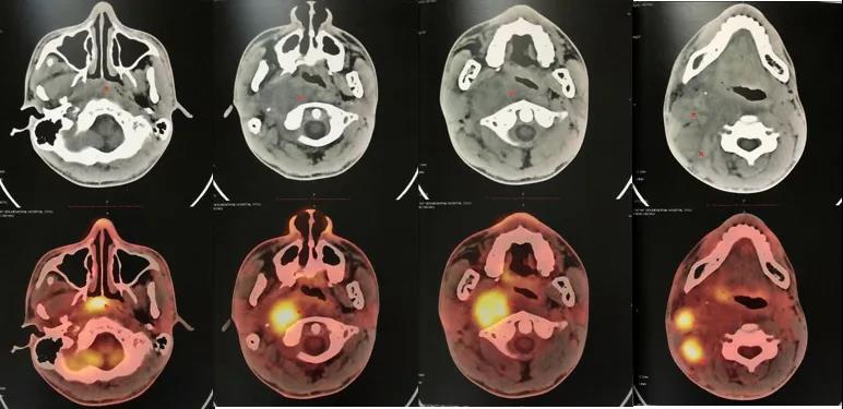 替雷利珠单抗联合化疗为IV期鼻咽癌患者带来局部治疗机会及后续更多希望！