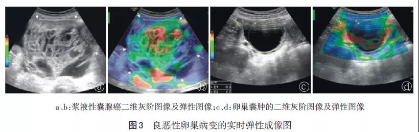 超声影像学在附件包块诊断中的应用