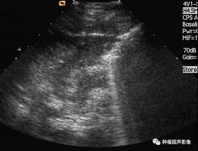 胃淋巴瘤的超声诊断及鉴别