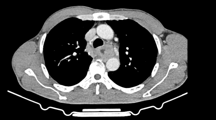 局部晚期食管癌患者应用新辅助免疫联合化疗2周期术后病理即达pcr